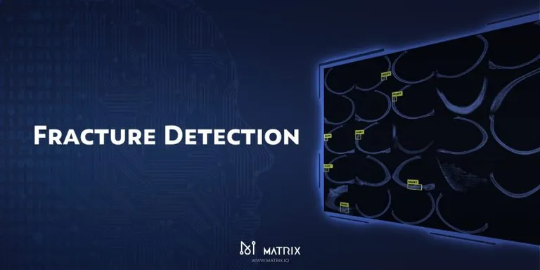 Matrixウォレットに骨折認識機能が追加される